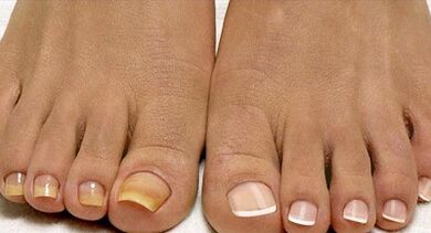 Flottenpilzbehandlungsmethoden