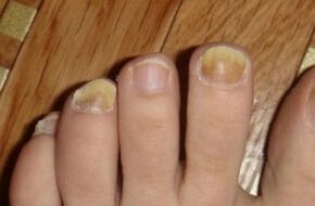 Gelbfärbung des Nagels durch Pilz