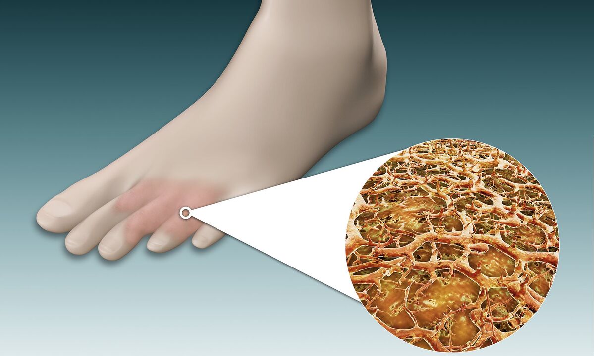 Pilzsporen an den Füßen